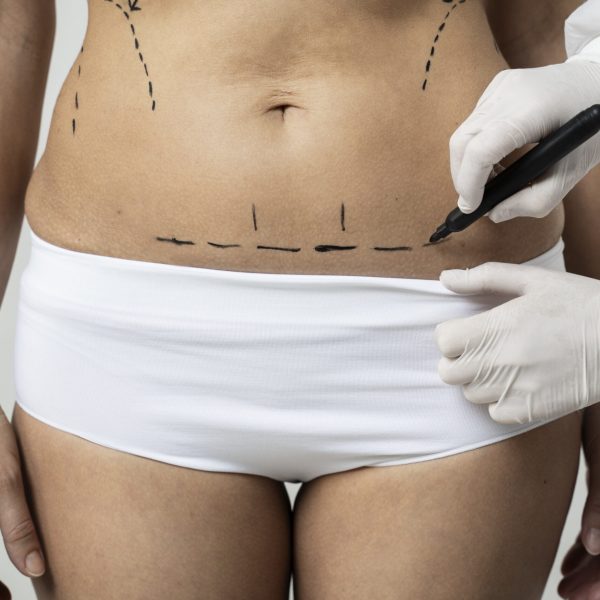 miniabdominoplastia